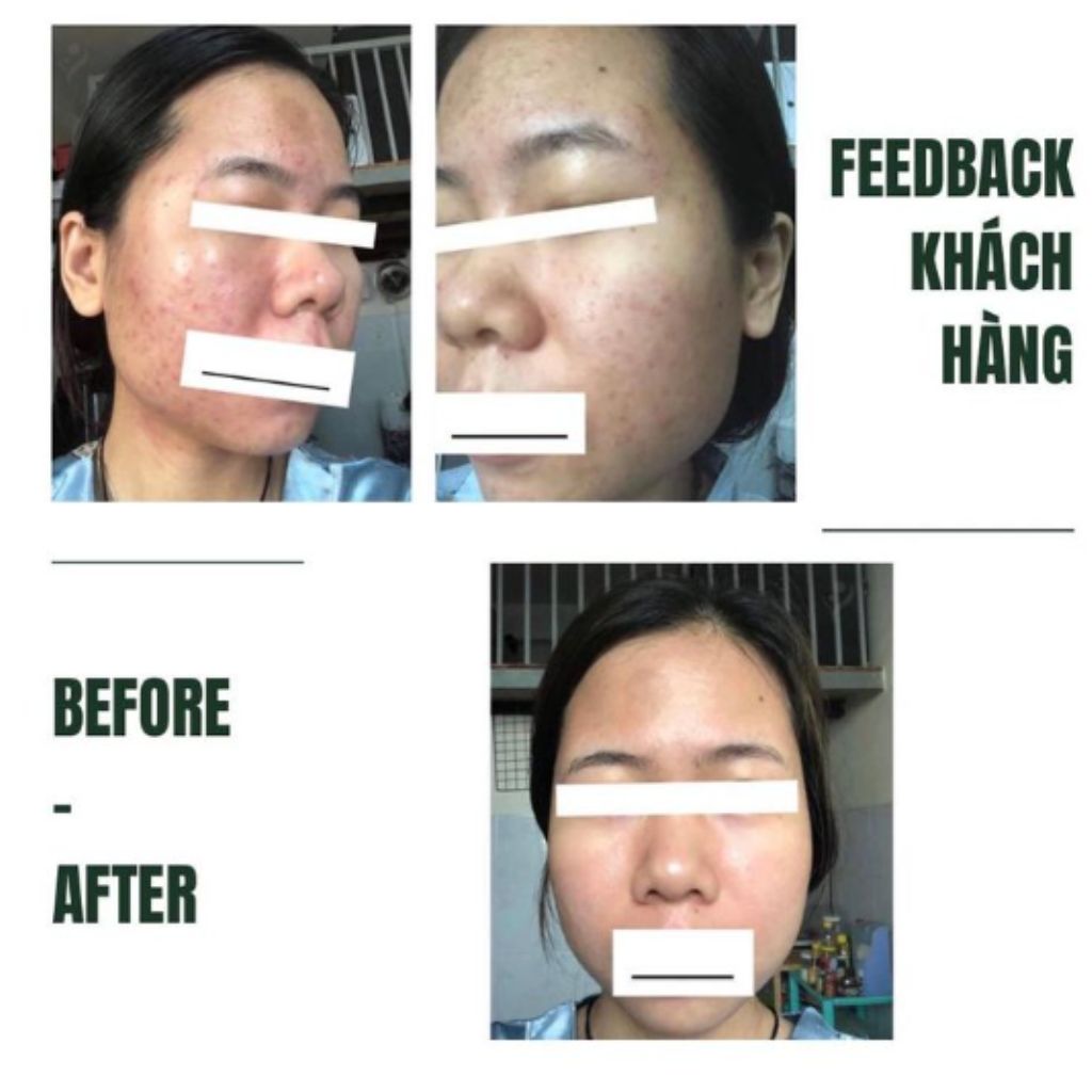 da mặt của khách hàng before after khi sử dụng dịch vụ tại felisa