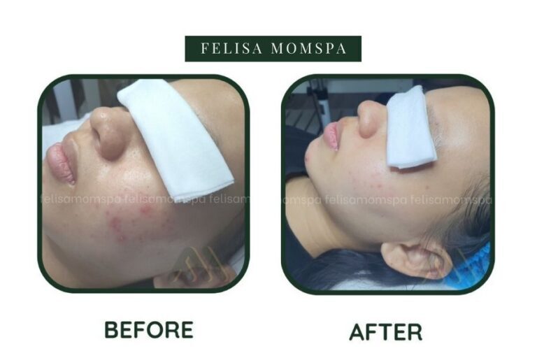 Da mặt before after khi sử dụng dịch vụ tại FElISA