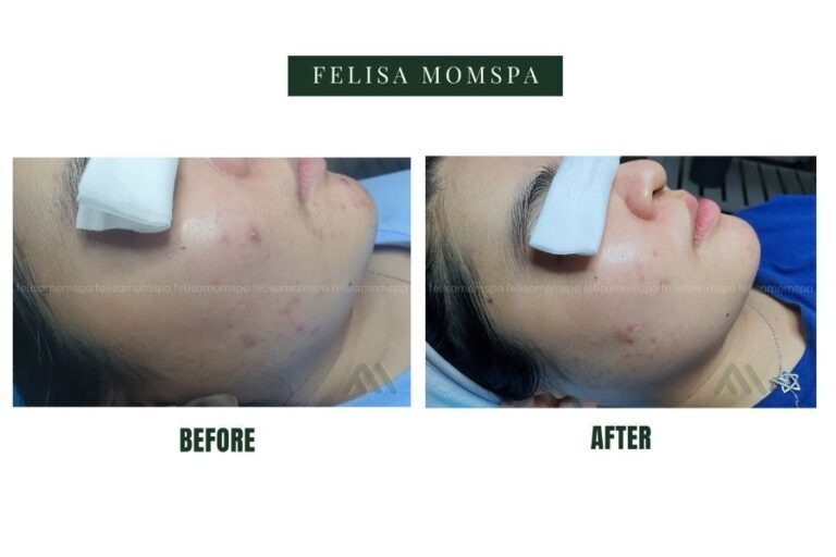 Da mặt của khách hàng before after khi sử dụng dịch vụ tại FElISA
