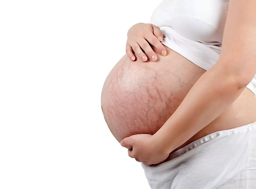 Biểu hiện rạn da khi mang thai 