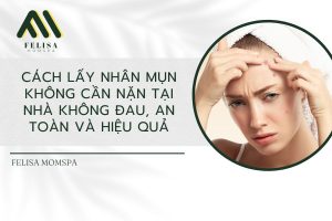 Cách lấy nhân mụn không cần nặn