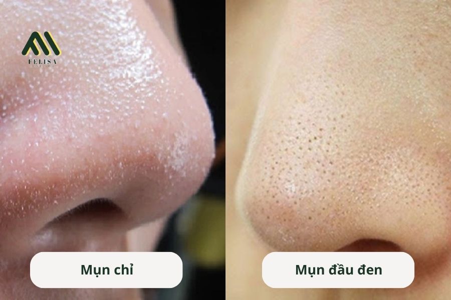 Phân biệt mụn đầu đen và sợi chỉ