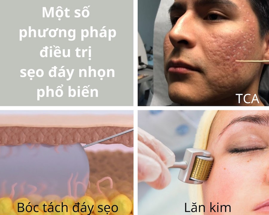 Phương pháp điều trị sẹo đáy nhọn