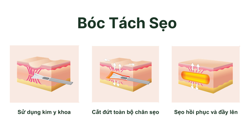 Quy trình thực hiện cắt đáy sẹo