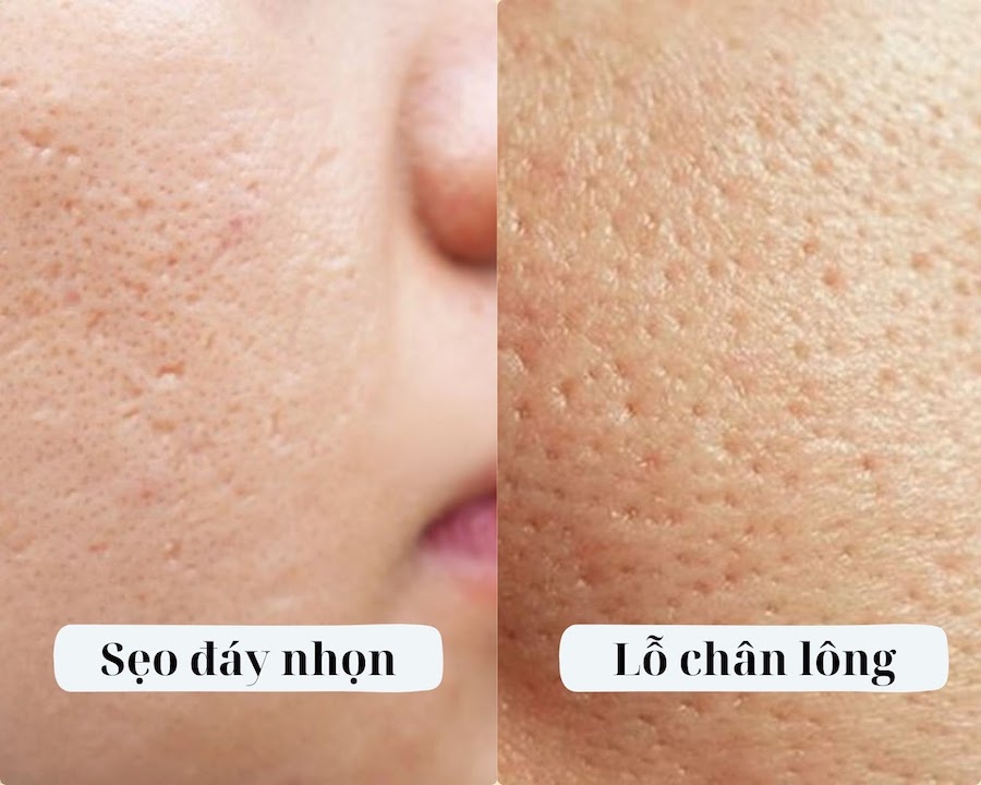 sẹo đáy nhọn và lỗ chân lông